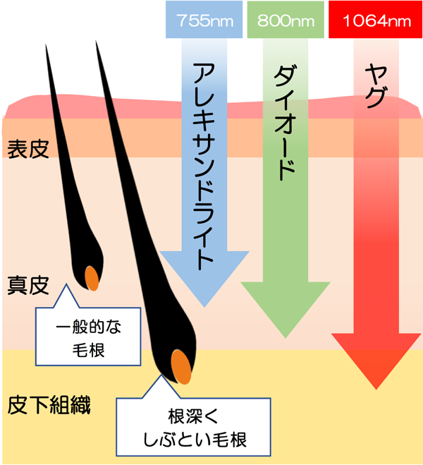 医療脱毛波長の種類
